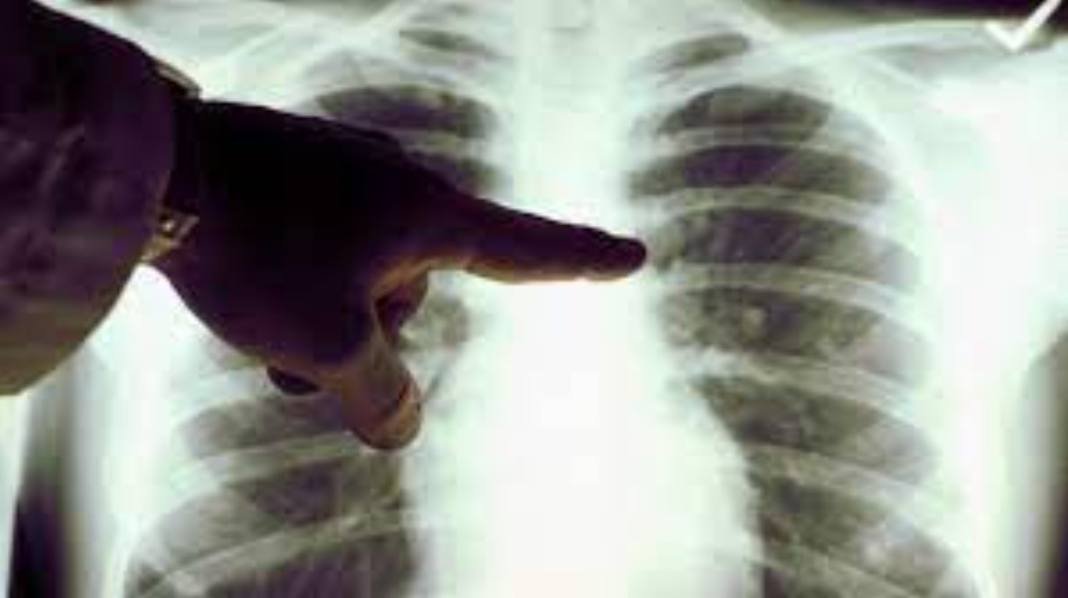 Tuberculose pronostic précoce Lutte contre la tuberculose : l'importance du diagnostic précoce