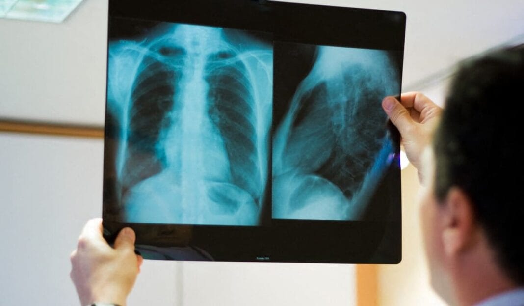 Tuberculose les spécialistes appellent à la vigilance